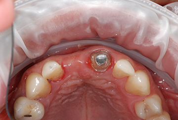 L'aménagement des tissus gingivaux dans le cadre des traitements implantaires