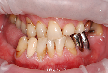 Il est possible de corriger des situations pathologiques liées à une usure importante des dents.