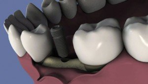 implant-dentaire-rouen-perol-300x171