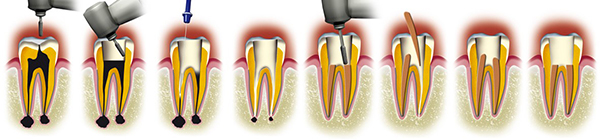 Étapes retraitement endodontique