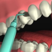 parodontologie-rouen-perol-thibault-dentiste