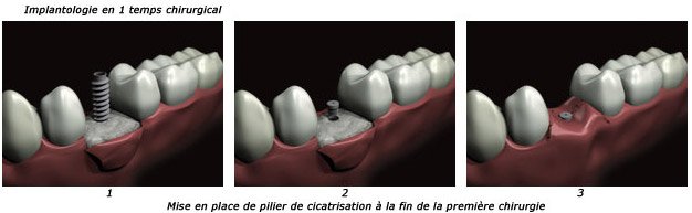 bridge-dentaire-implantologie-rouen