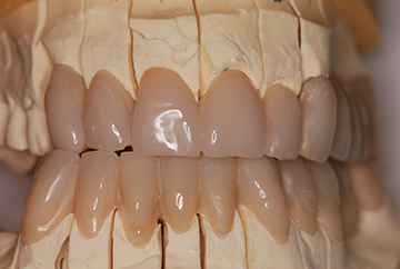 Les dents provisoires peuvent être réalisées