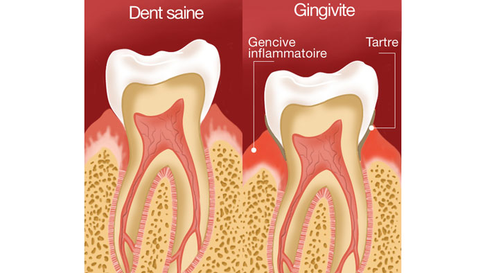 Dent saine vs gingivite
