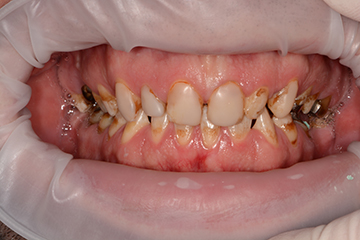 dents 1