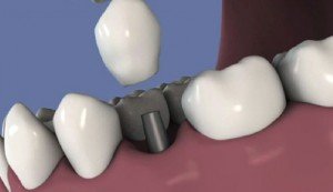 implant-dentaire-rouen-perol1-300x173