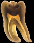 Dent avec retraitement endodontique
